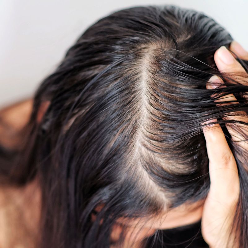 Thinning Hair