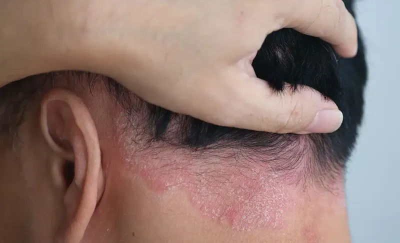 Scalp Irritation