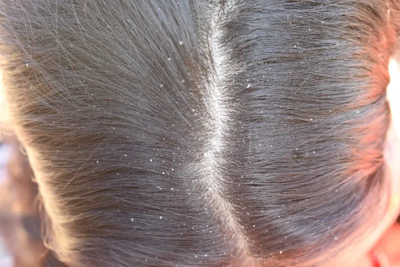 Dandruff is Unacceptable