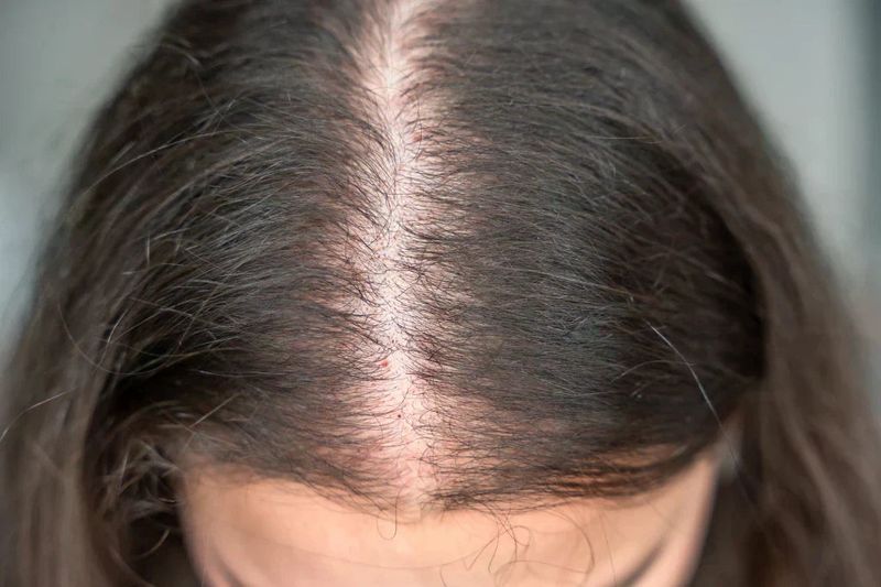 Thinning Hair
